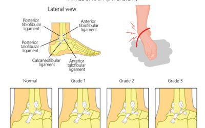 Inversion Ankle Sprain