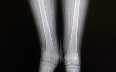 Short Leg deficiencies