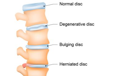 Spinal degeneration