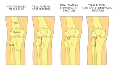 Knee fractures